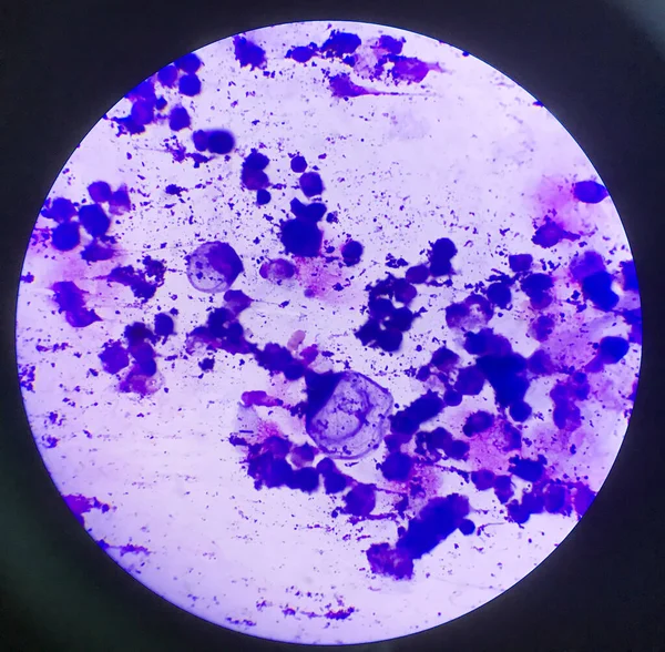 体内流体スミアの異常細胞 理化学研究所 — ストック写真