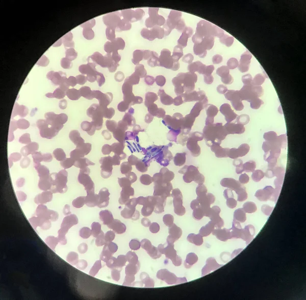 酵母細胞の血液中の白血球による食作用 真菌の血液感染医学的背景 ストックフォト