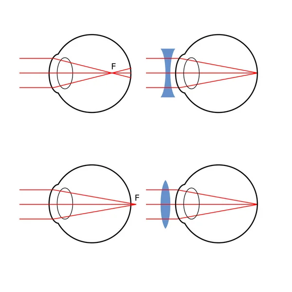 Deficiência visual e sua correção — Vetor de Stock