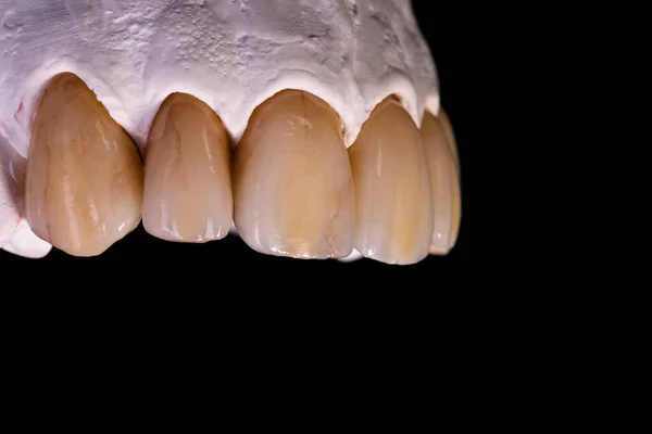 Zahnkronen. Keramische Zahnkrone in Großaufnahme — Stockfoto
