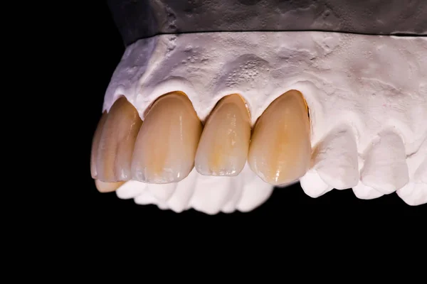 Coronas dentales. Primer plano corona de dientes de cerámica — Foto de Stock