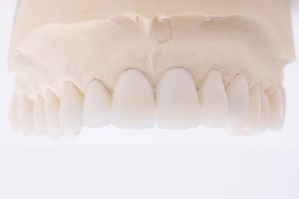 Zahnkronen. Keramische Zahnkrone in Großaufnahme — Stockfoto