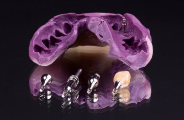 Diş implantı, insan dişleri, yakın plan. Diş teknolojisi kavramı