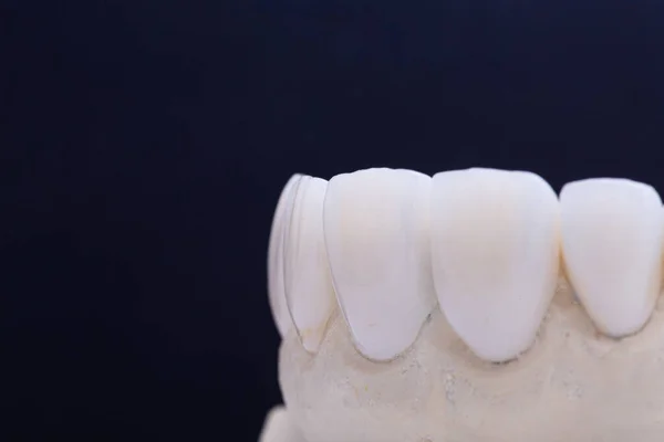 Coroas dentárias. Close-up coroa de dentes de cerâmica — Fotografia de Stock