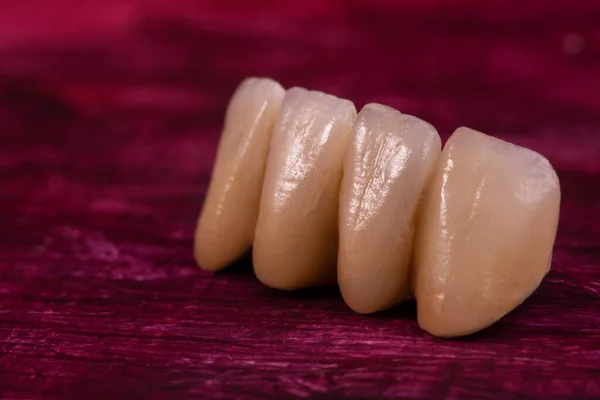 Chapas de cerámica dental Coronas en rojo. Cerrar corona de dientes — Foto de Stock