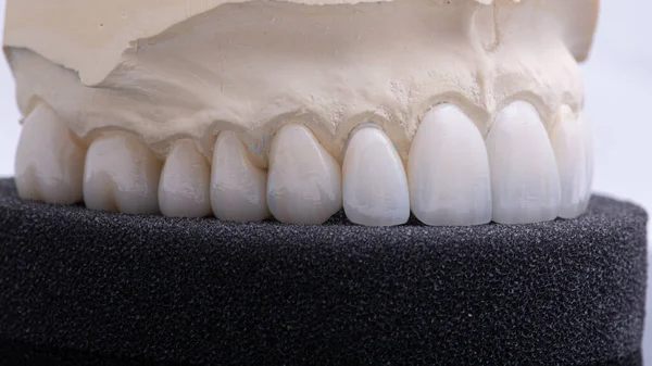 Coronas dentales. Primer plano corona de dientes de cerámica — Foto de Stock