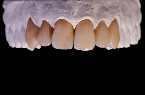 Ceramiczne okleiny na czarnym tle. Koncepcja zębów dentystycznych — Zdjęcie stockowe