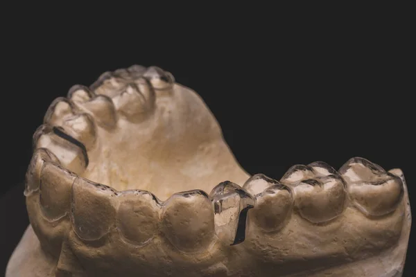 Aligner claro ou retentor para os dentes para pacientes ortodônticos em um modelo — Fotografia de Stock