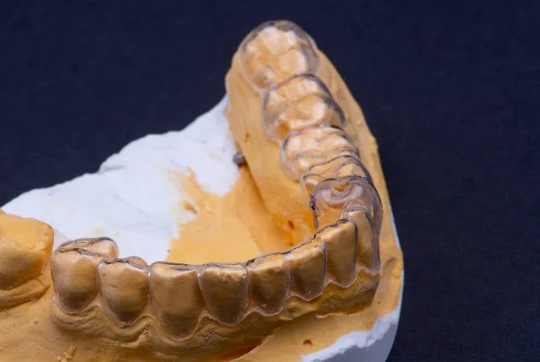 Schiarente o fermo denti per pazienti ortodontici su un modello — Foto Stock