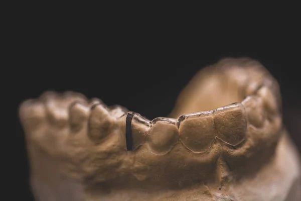 Klare Ausrichtung oder Halterung der Zähne für kieferorthopädische Patienten an einem Modell — Stockfoto