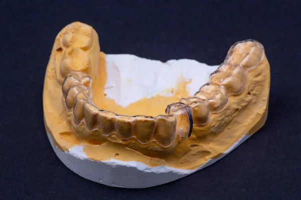 Klar linje eller tandställning för tandprotespatienter enligt en modell — Stockfoto