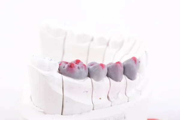 Trabajo de prótesis dental. Diente artificial, prótesis, dientes postizos —  Fotos de Stock