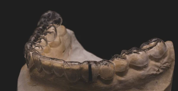Przezroczysty korektor lub uchwyt do zębów dla pacjentów ortodontycznych na modelu — Zdjęcie stockowe