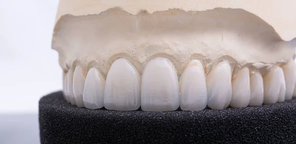 Coroas dentárias. Close-up coroa de dentes de cerâmica — Fotografia de Stock