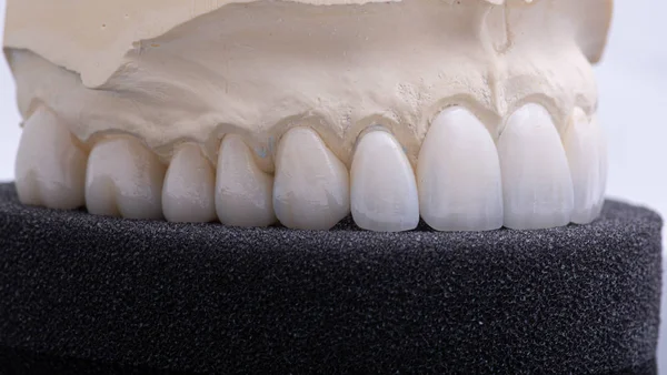 Coronas dentales. Primer plano corona de dientes de cerámica — Foto de Stock