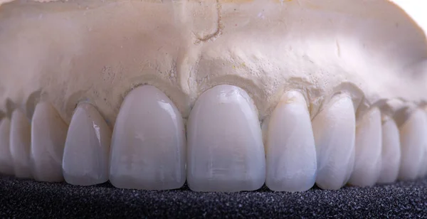 Corone dentali. Primo piano corona di dente in ceramica — Foto Stock