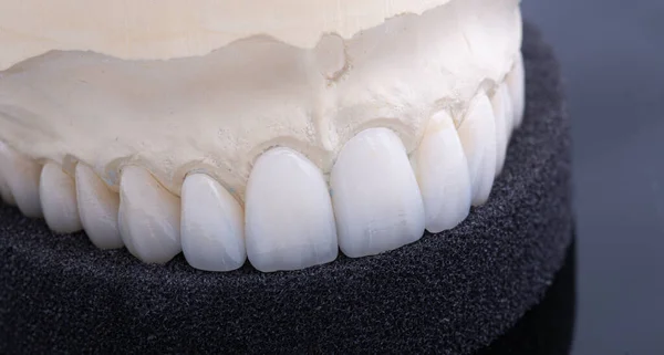Koronki dentystyczne. Zbliżenie ceramiczna korona zęba — Zdjęcie stockowe