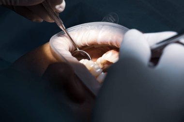 Doktor diş hizalayıcı diş tutucuları görünmez tutucuları hastanın ağzına koydu.
