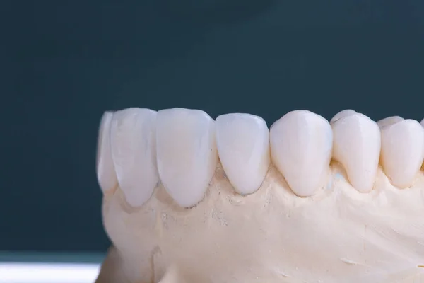 Couronnes dentaires. Gros plan couronne de dent en céramique — Photo
