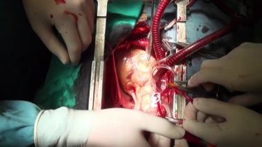 İnsan kalp ameliyatı profesyonel doktor eller benzersiz makro video Kliniği.