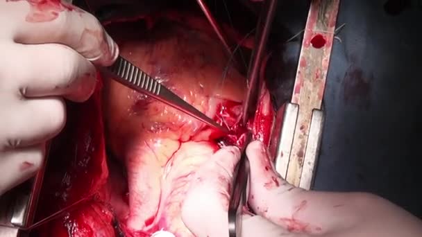 Battito cardiaco nelle mani di un medico professionista durante un intervento chirurgico in clinica . — Video Stock