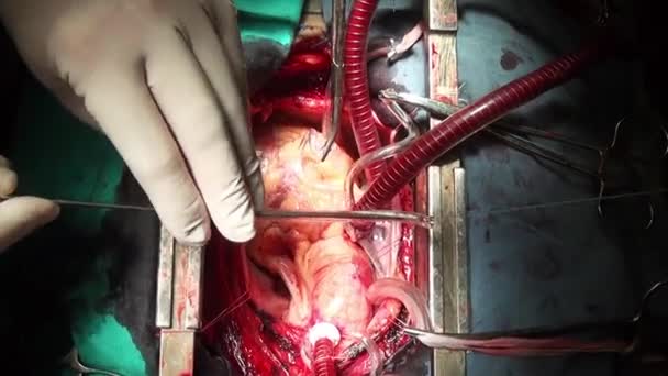 Mänskliga hjärtat kirurgi professionella läkare händerna unika makro video i klinik. — Stockvideo