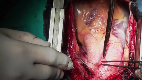 Cirugía del corazón profesional médico manos único macro video de cerca en la clínica . — Vídeos de Stock