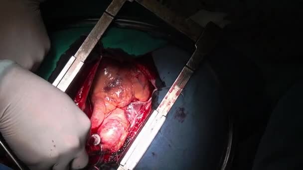 Cirugía del corazón profesional médico manos único macro video de cerca en la clínica . — Vídeos de Stock