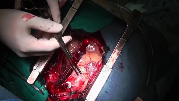 Cirugía del corazón profesional médico manos único macro video de cerca en la clínica . — Vídeo de stock