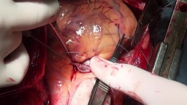 Herzschlag in den Händen eines professionellen Arztes während der Operation in der Klinik. — Stockvideo