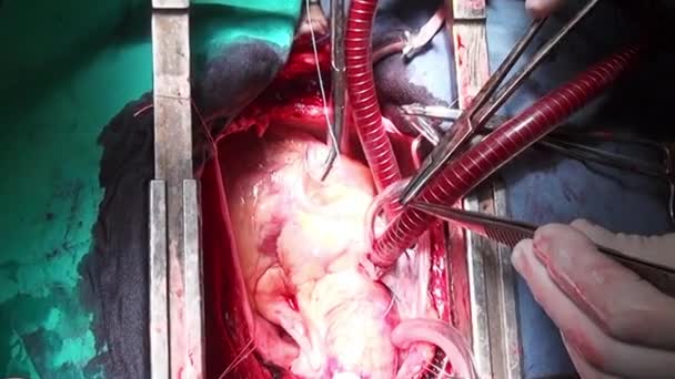 Ανθρώπινη καρδιά χειρουργική επέμβαση επαγγελματία γιατρό χέρια μοναδικό μακροεντολή βίντεο στην κλινική. — Αρχείο Βίντεο