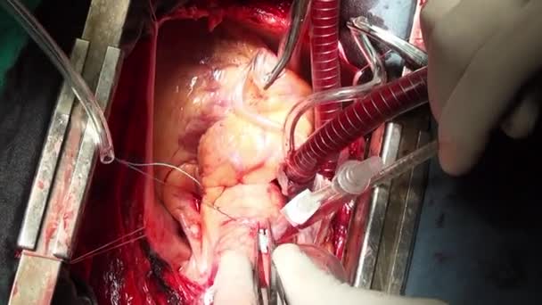 Human heart surgery professional doctor hands unique macro video in clinic. — Stock Video