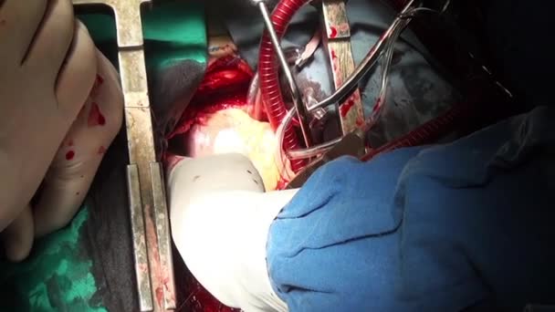 Human heart surgery professional doctor hands unique macro video in clinic. — Stock Video