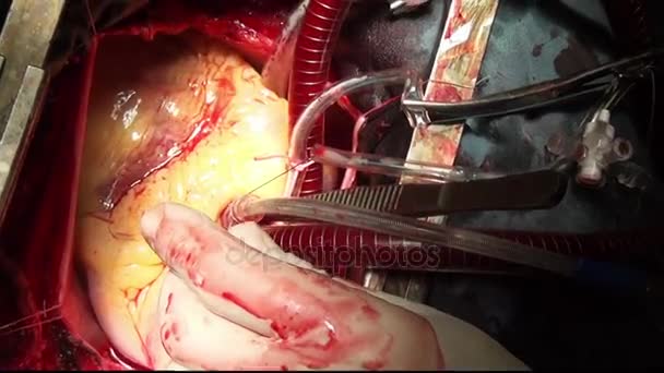 Cirugía del corazón profesional médico manos único macro video en la clínica . — Vídeo de stock