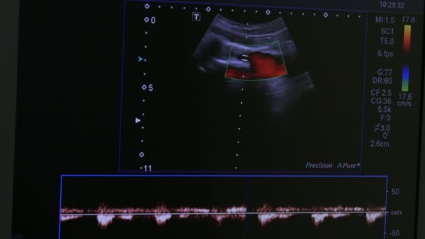 Obraz žena dělohu na monitoru ultrazvukového vyšetření zařízení. — Stock video