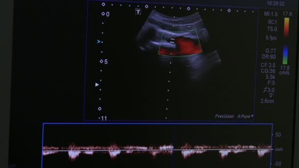 Imagem do útero da mulher no equipamento de exame de ultra-som monitor . — Vídeo de Stock