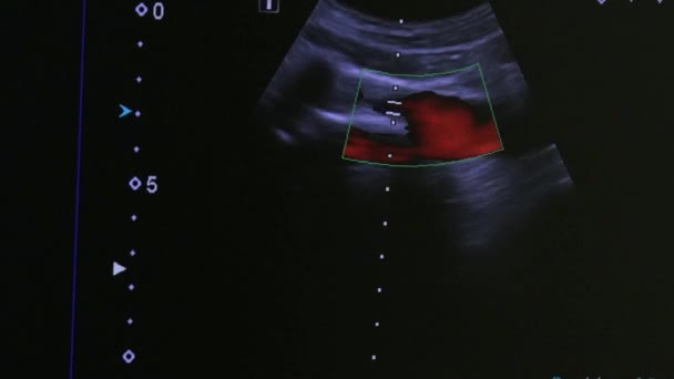 Imagem do útero da mulher no equipamento de exame de ultra-som monitor . — Vídeo de Stock