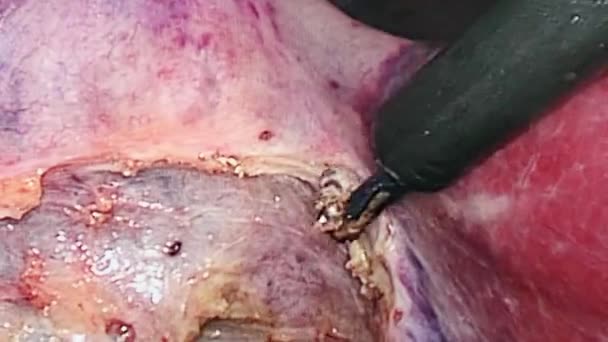 Jamy brzusznej wewnątrz podczas operacji Laparoskopia. — Wideo stockowe