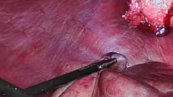 Břišní dutina uvnitř během operace laparoskopie. — Stock video