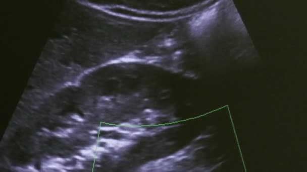 Image of woman uterus on monitor ultrasound examination equipment. — Stock Video