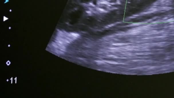 Obraz žena dělohu na monitoru ultrazvukového vyšetření zařízení. — Stock video