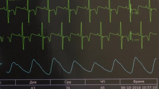 Cardiografía del ritmo cardíaco e imagen del pulso en el monitor durante la operación . — Vídeo de stock