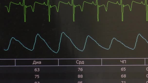 Cardiogram of rhythm of heart and pulse image on monitor during operation. — Stock Video