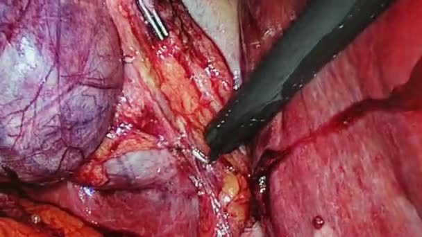 Bukhålan släpper under drift laparoskopi. — Stockvideo