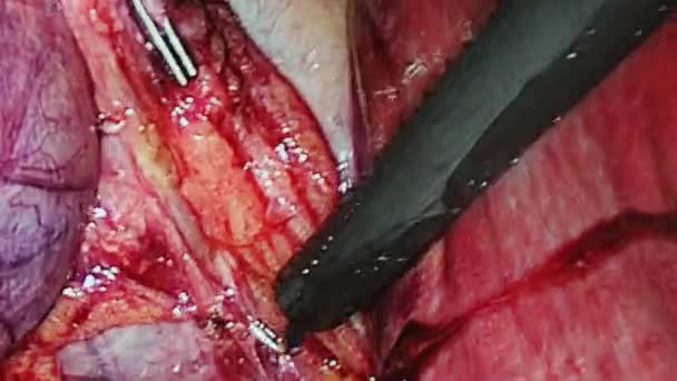 Abdominal cavity inside during operation laparoscopy. — Stock Video