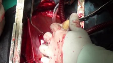 Kalp ameliyatı benzersiz makro video sırasında doktorun elinde klinikte kapat.