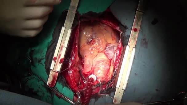 Cirurgia cardíaca profissional médico mãos único macro vídeo close-up na clínica . — Vídeo de Stock