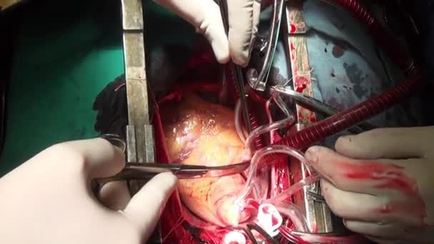 Human heart surgery professional doctor hands unique macro video in clinic. — Stock Video