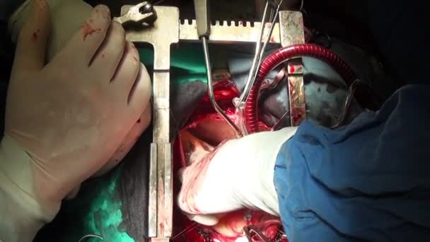 Corazón de Hombre cirugía profesional médico manos vídeo único de cerca en la clínica . — Vídeos de Stock