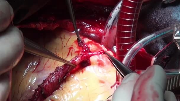 Cirurgia cardíaca profissional médico mãos único macro vídeo na clínica . — Vídeo de Stock